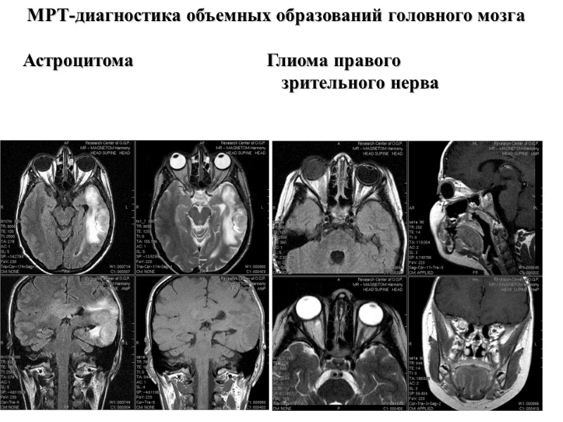 МРТ-диагностика объемных образований головного мозга  Астроцитома       Глиома